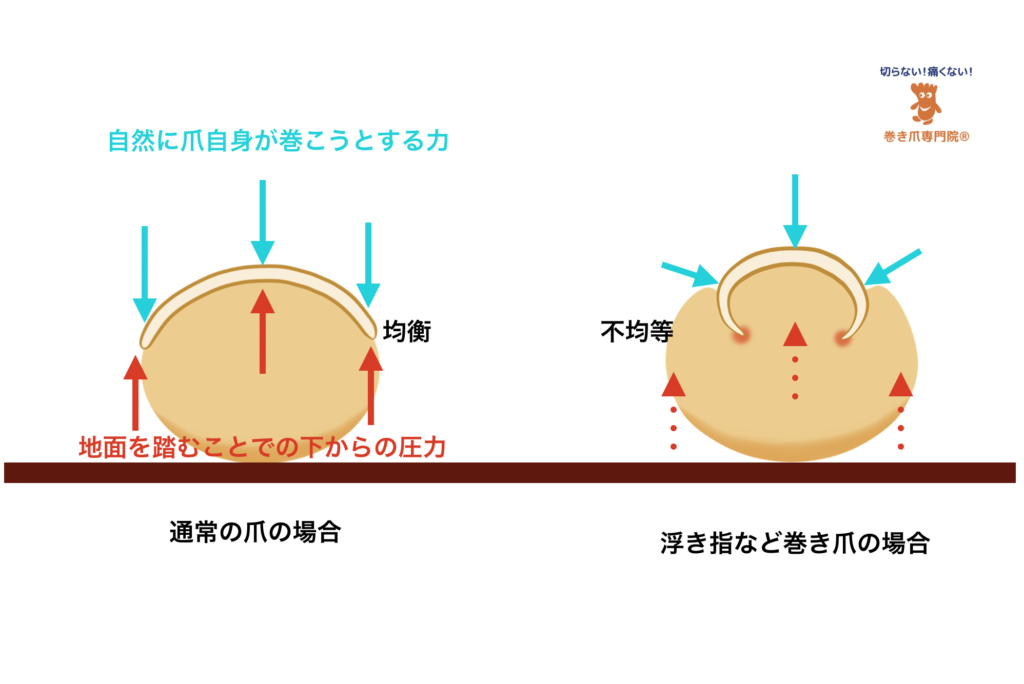 浮き指問題の爪の圧力バランス